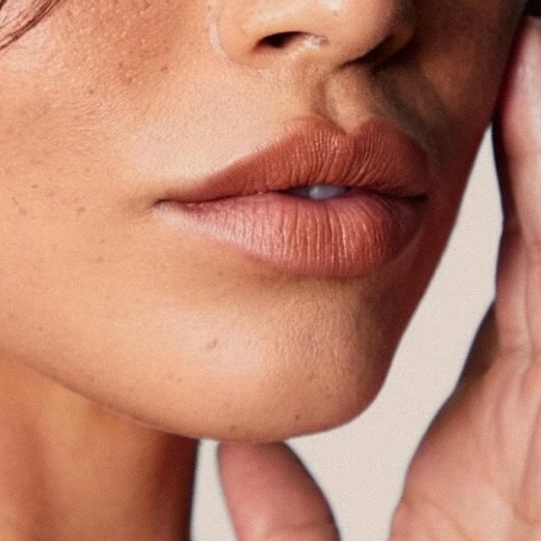 Dr Thomas de Laâge de Meux – Illustration du Liplift