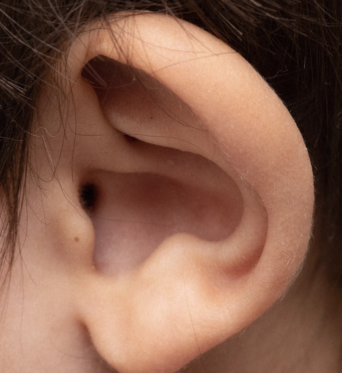 Dr Thomas de Laâge de Meux – Illustration de l'Otoplastie