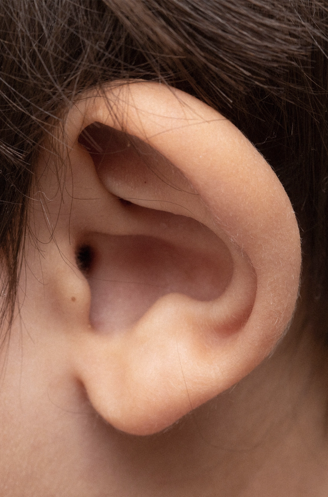 Dr Thomas de Laâge de Meux – Illustration de l'Otoplastie