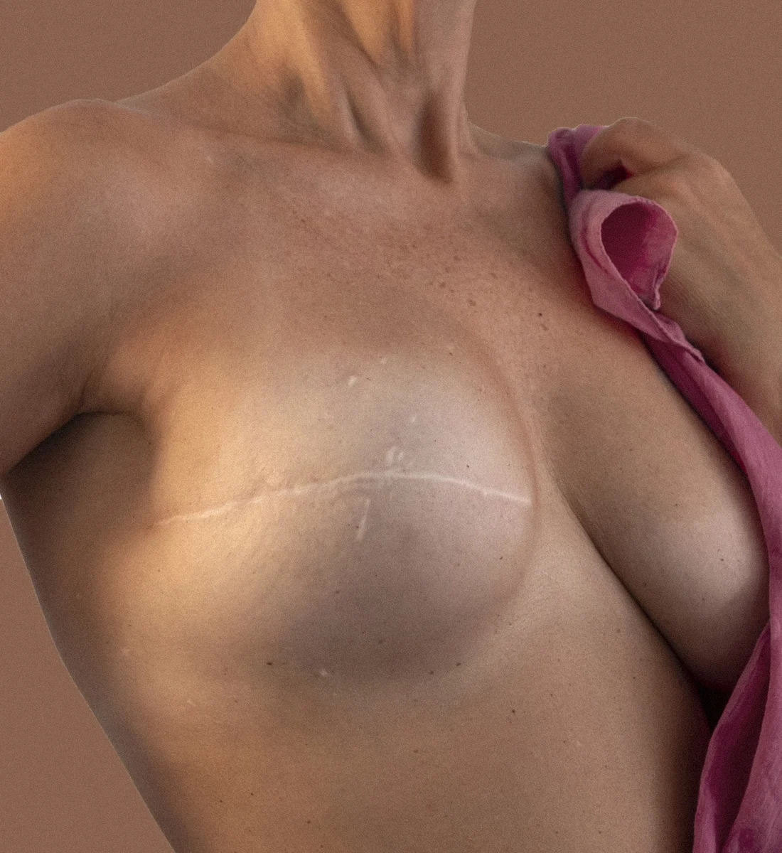 Dr Thomas de Laâge de Meux – Illustration de la reconstruction mammaire