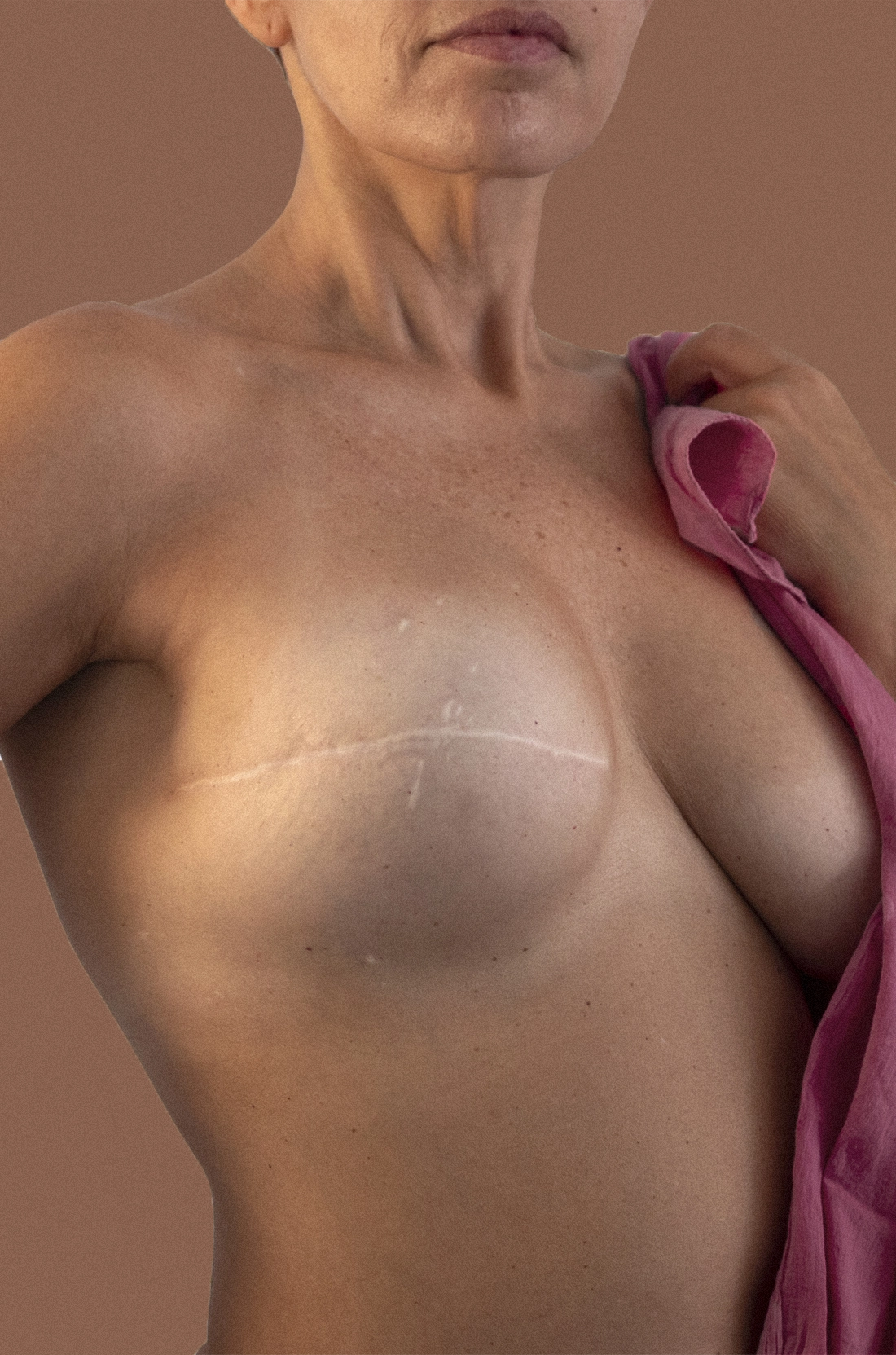 Dr Thomas de Laâge de Meux – Illustration de la reconstruction mammaire