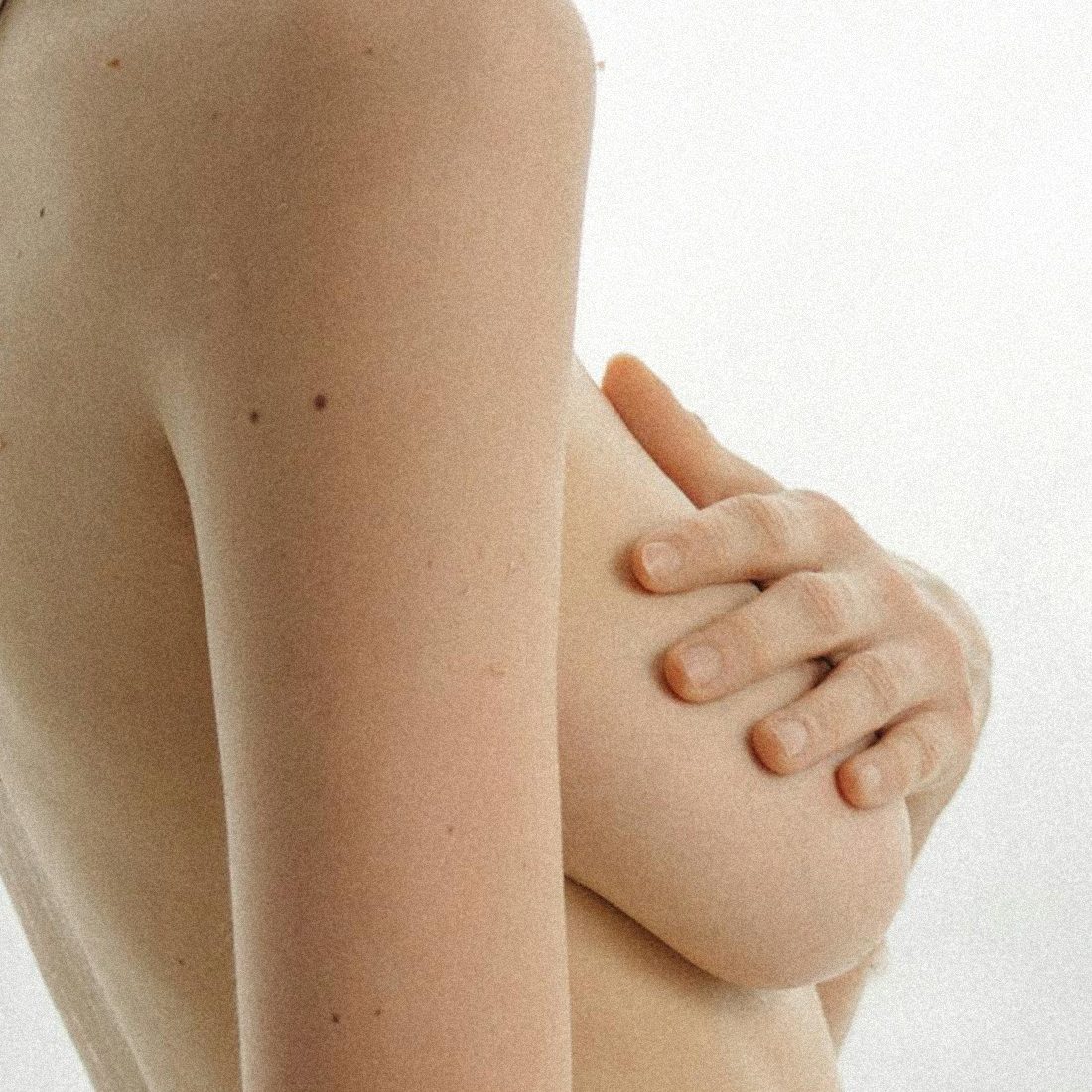 Dr Thomas de Laâge de Meux – Illustration des seins tubéreux