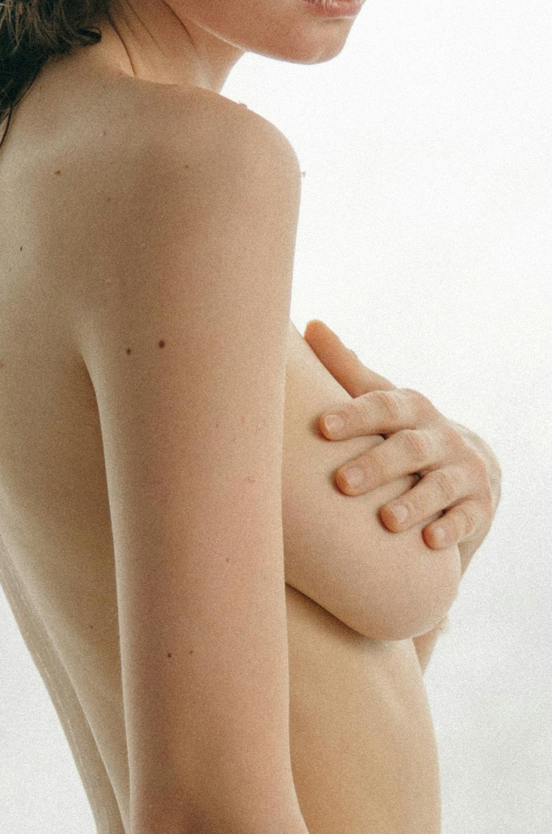 Dr Thomas de Laâge de Meux – Illustration des seins tubéreux