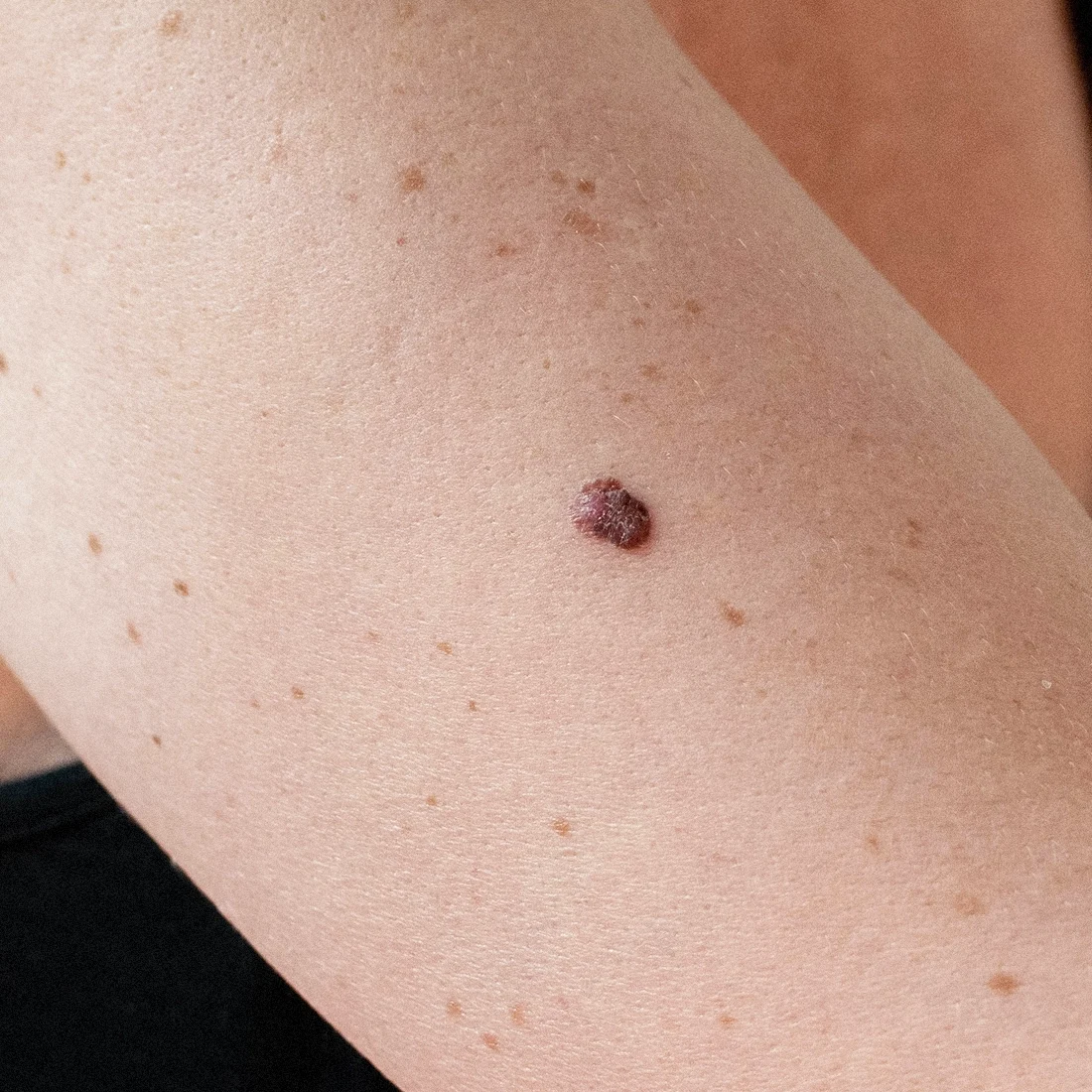 Dr Thomas de Laâge de Meux – Illustration des tumeurs cutanées