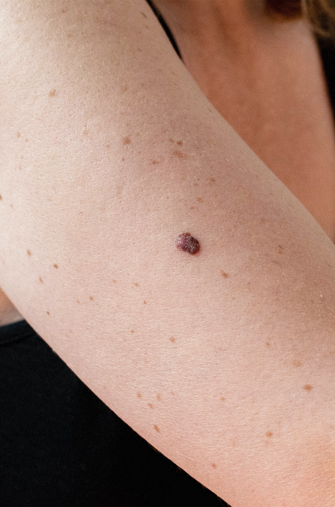 Dr Thomas de Laâge de Meux – Illustration des tumeurs cutanées