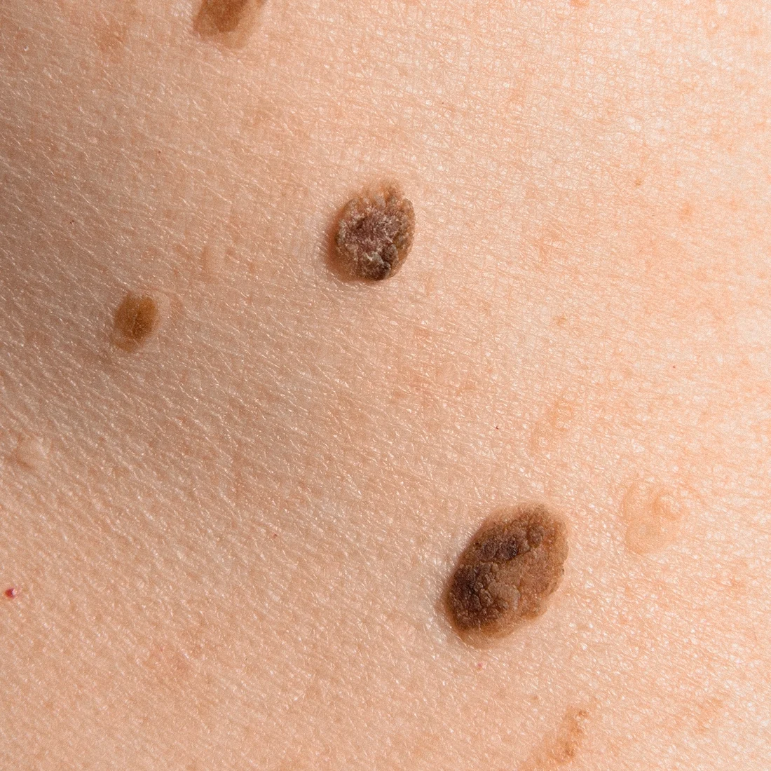 Dr Thomas de Laâge de Meux – Illustration des carcinomes cutanés