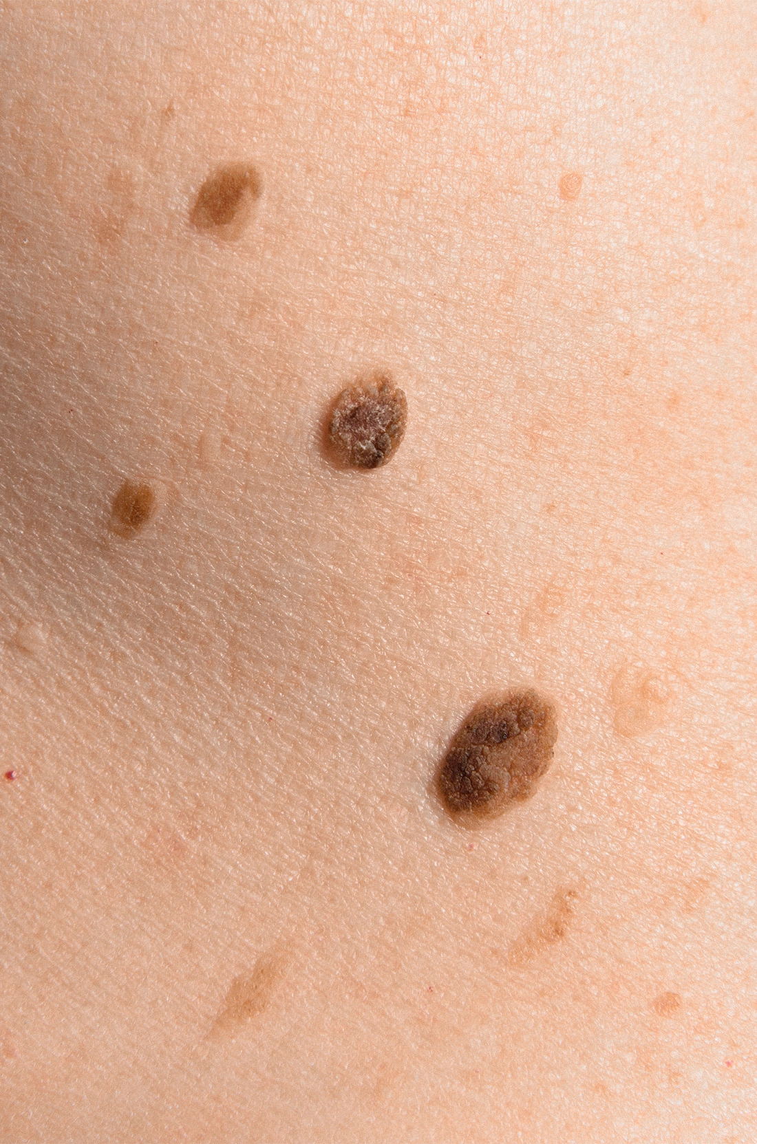 Dr Thomas de Laâge de Meux – Illustration des carcinomes cutanés