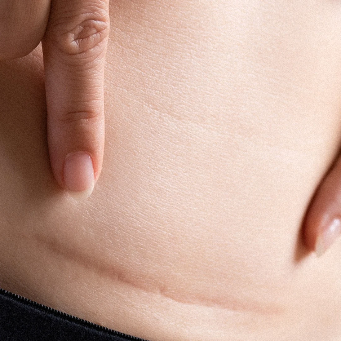 Dr Thomas de Laâge de Meux – Illustration des cicatrices inesthétiques