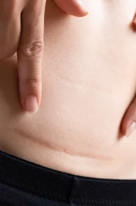 Dr Thomas de Laâge de Meux – Illustration des cicatrices inesthétiques